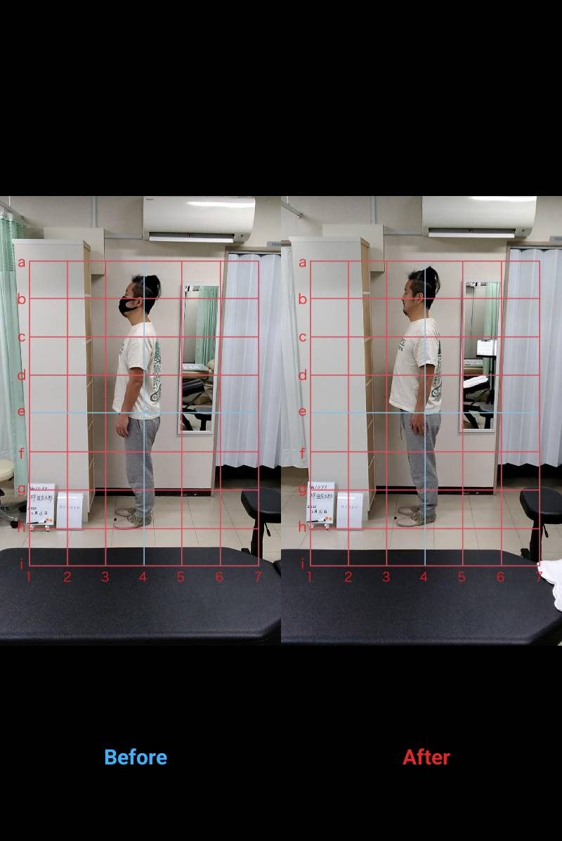 姿勢ビフォーアフター 症例3