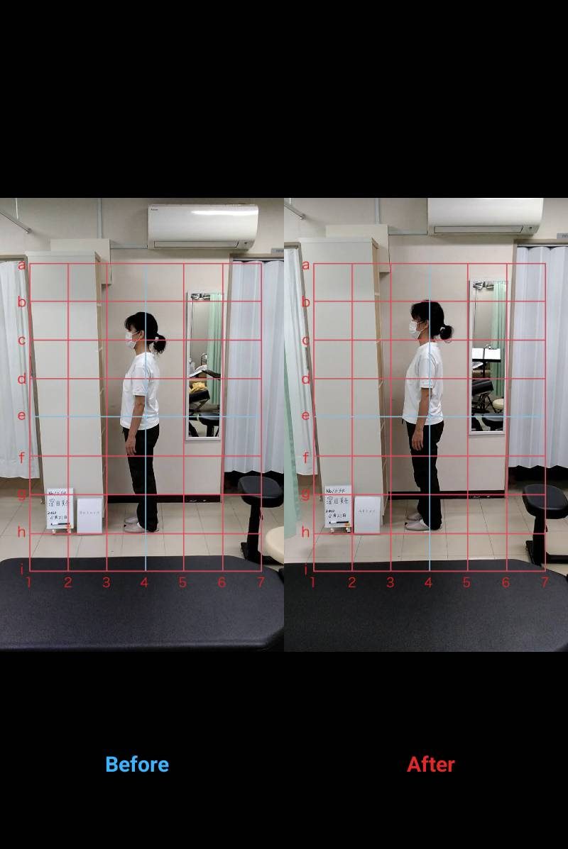姿勢ビフォーアフター 症例4
